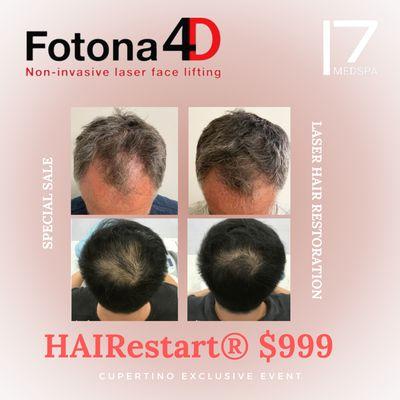 Restart your hair growth with Fotona 4D HAIRestart!