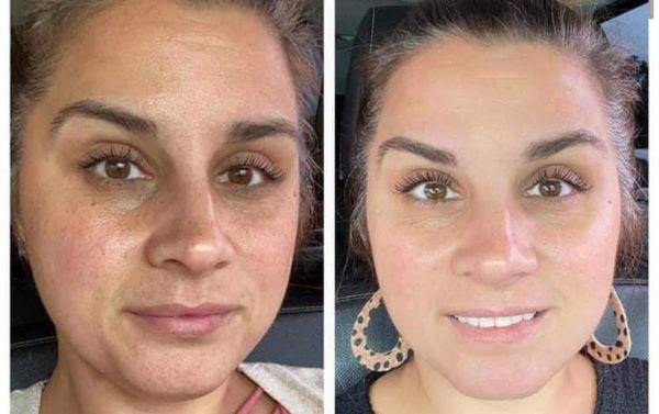 Before and After Chemical Peel Service