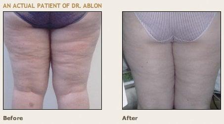 Cellulite Treatment