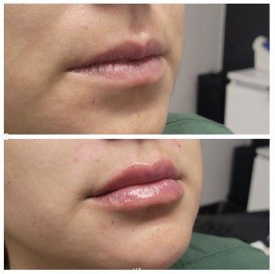 Before and after lip filler using Restylane Kysse.