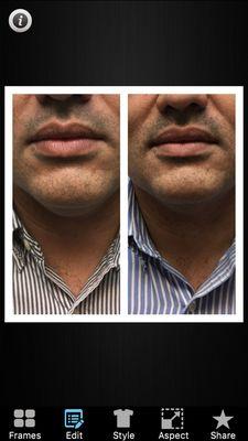 Trusculpt3d on the neck amazing results