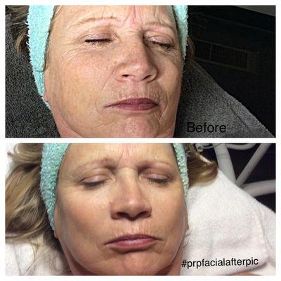 PRP Micro-needling Facial.