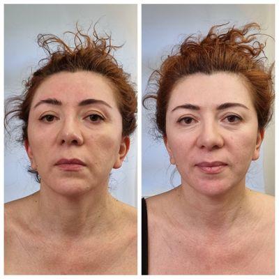 Before/after 1 treatment