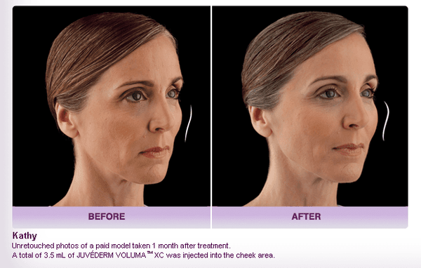 FDA Approved, Voluma is an injectable facial filler. It temporarily restores volume to the mid-face