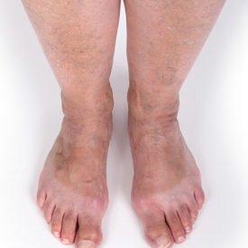 Radiofrequency Ablation (RFA) is a powerful venous insufficiency treatment for those suffering from venous disease. Visit our site for info.