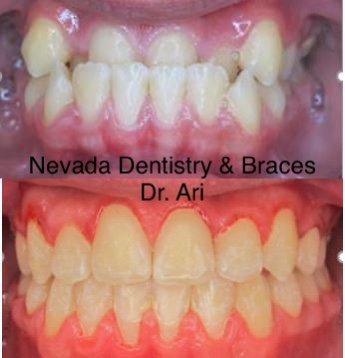 Bite correction without performing any extraction in 18 months!