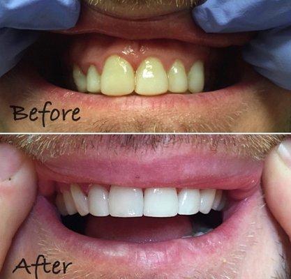 before and after - male smile