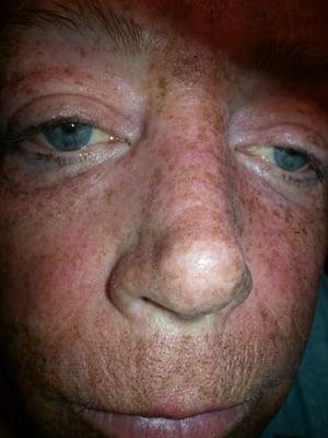 1st  day after lazer..all my freckles were there..now on day 6 there gone..