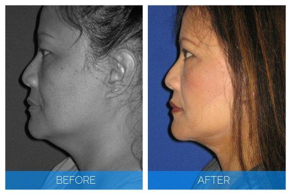 miniLift: The facelift with the faster recovery