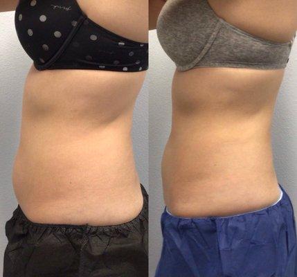 Another amazing result with CoolSculpting Elite!