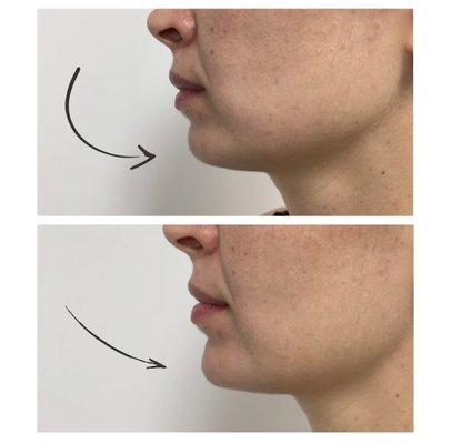 Before and After Chin Augmentation using Juvederm Ultra Plus XC