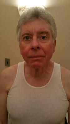 Patient after bells palsy treatment  (After)