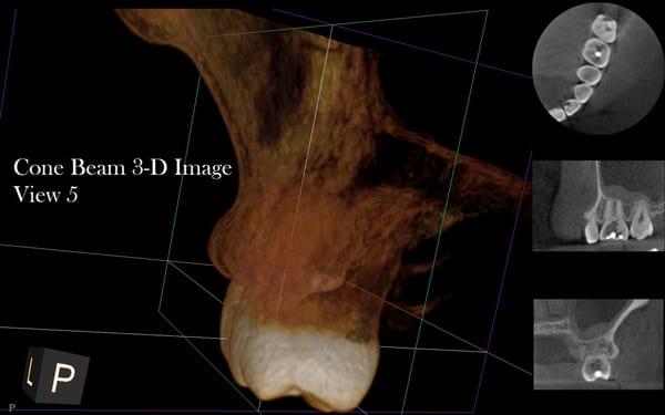 Fifth view of a Cone Beam 3-D image of Internal Root Resorption