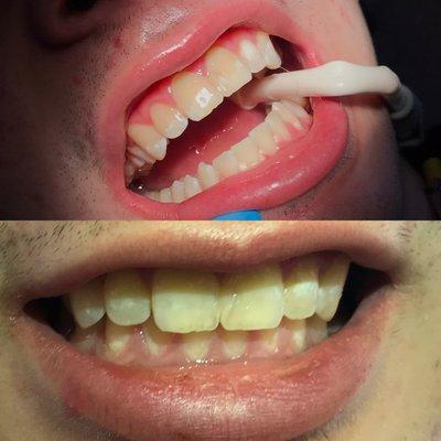 Before & After In-office whitening first session