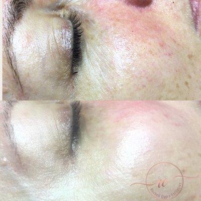 Nanoinfusion eye and lip treatment with signature facial produces immediate results in just one treatment!