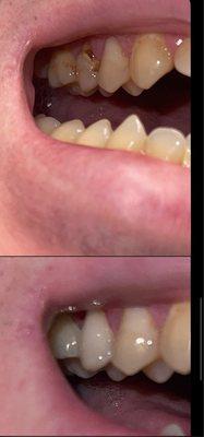 Cavity filling results