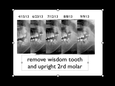 many orthodontics want  to remove both teeth and put implant,but  only take me 6 months to upright it and no need for implant,