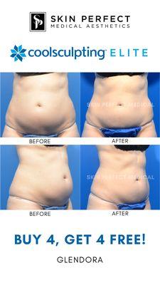 CoolSculpting Elite Kills fat forever! Call for a consultation today!