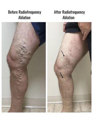 Patient is a 55-64 y/o male treated with radiofrequency ablation and medical sclerotherapy. Photo was taken 1 week post-operatively.