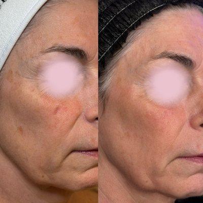 Before & After BBL/MOXI Laser Treatment