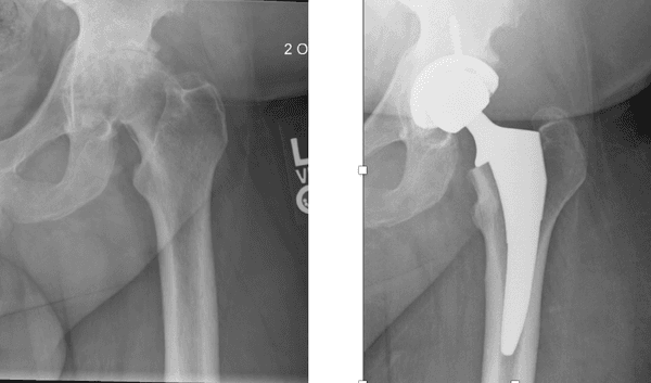 Before and After Anterior Hip Replacement