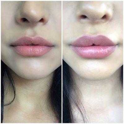 Before and after lip injections (by Ebu)