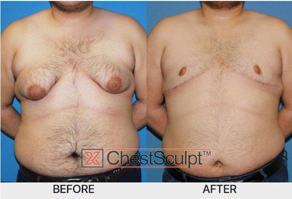 Patient underwent ChestSculpt procedure to correct Gynecomastia. Bilateral mastectomy with nipple graft. Surgeon: Dr. Anh Tuan Truong