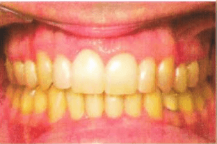 Before starting an orthodontic treatment.