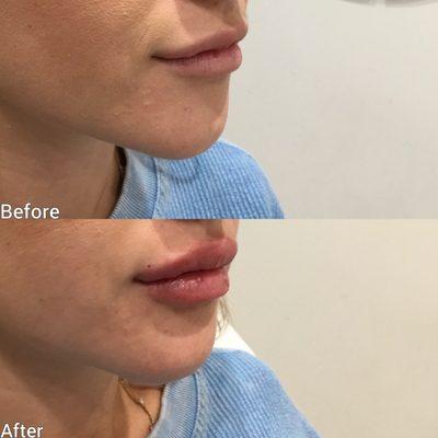 Your lip filler side profile is just as important as the front view! We are in love with these lips!