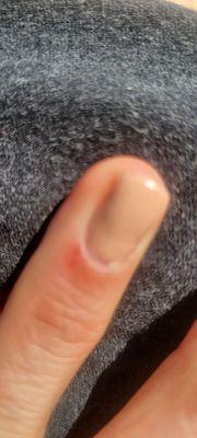 Hurt cuticle