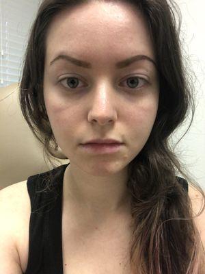 Follow up appointment at Joslyn med spa (Lip Filler)