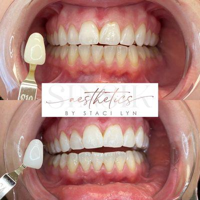 30 minute Classic Whitening session