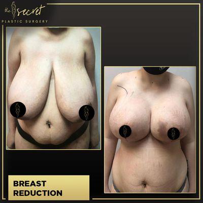 Breast Reduction Miami - The Secret Plastic Surgery