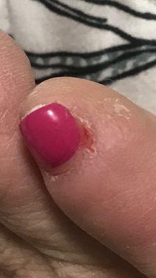 Close up of pinky toe-with dry skin still attached ‍