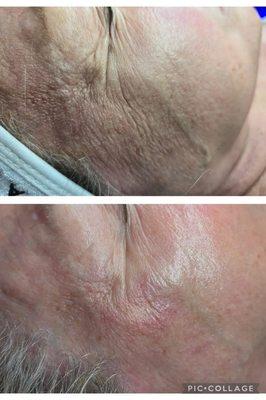 This client had series of Biorepeel and customize facials and home care. 
# facial # Biorepeel # chemical peel