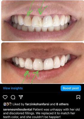 Replaced and color matched patients fillings