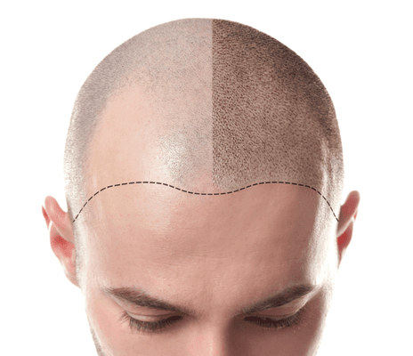 SMP (Scalp Micro-Pigmentation) - Hair like follicles via cosmetic tattoo for a fuller, thicker hair look.