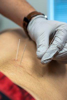 Dry Needling for Low Back Pain