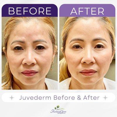 8 Months after subtle enhancement of cheeks with 2 syringes of Juvederm Voluma