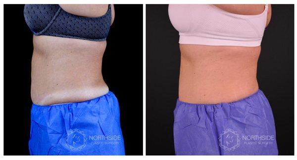 Coolsculpting - Upper Abdomen