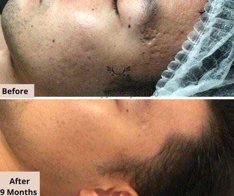 Remove scars without surgery after 9 months.