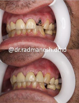 Restoring Severely Broken Down Tooth