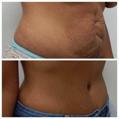 Top: Before Tummy Tuck Bottom: After Tummy Tuck