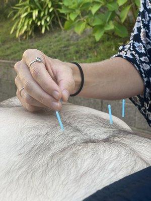 Acupuncture