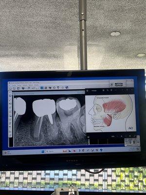 My old root canal was so junky and the lady stuck a whole screw inside my tooth!