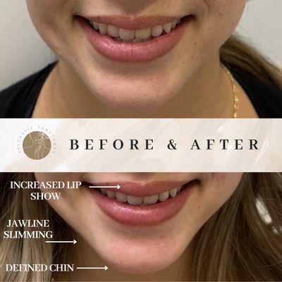 Only one week after a lip flip and masseter tox for clenching and jawline slimming. *Results may take 2-4 weeks for full effect.*