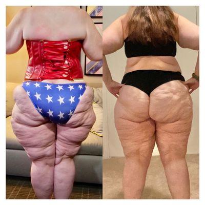 Before and after 2 lipedema removal surgeries.