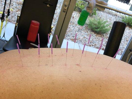 Dry needling available here!