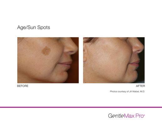 Sunspot removal with Alexandrite laser