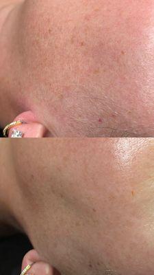 Before + After Dermaplane Facial